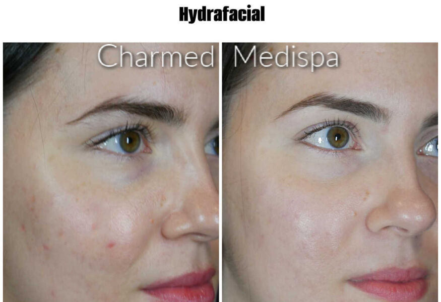 Improve acne and redness with ZO Skin Health and our medical grade protocol at Charmed Medispa