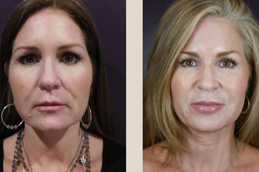 Charmed Medispa fillers used to lift and contour the face, cheeks, lips and jawline