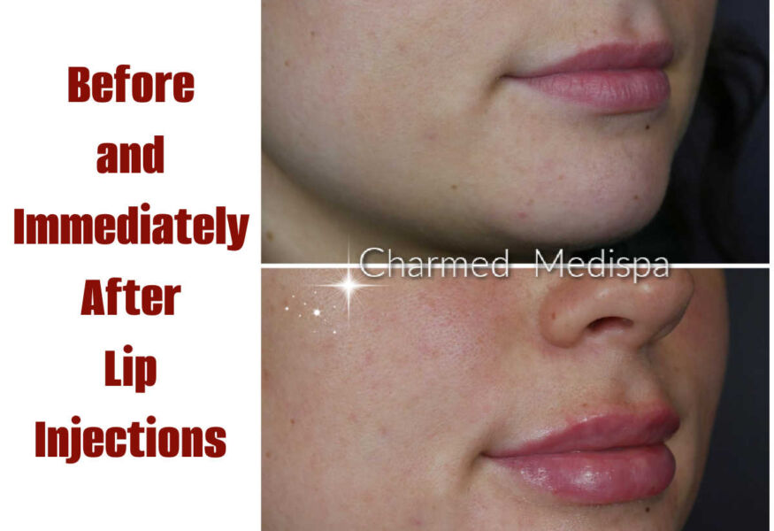 Lip injections with dermal filler to create smoother, plumper and natural looking lip volume. Charmed Medispa in Delaware has expert lip injection techniques.