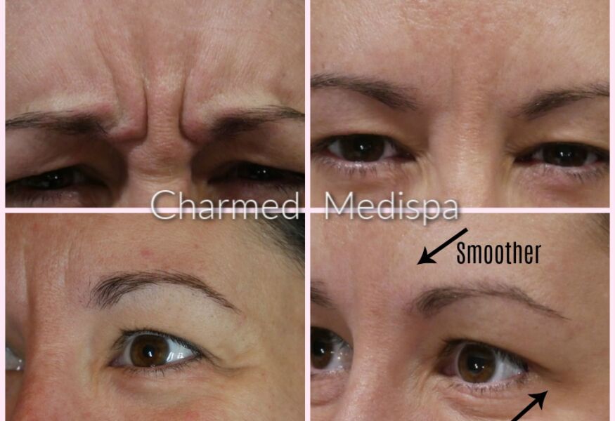 Dysport between the brows and crow's feet. The Dysport lifted the skin and significantly improved wrinkles.