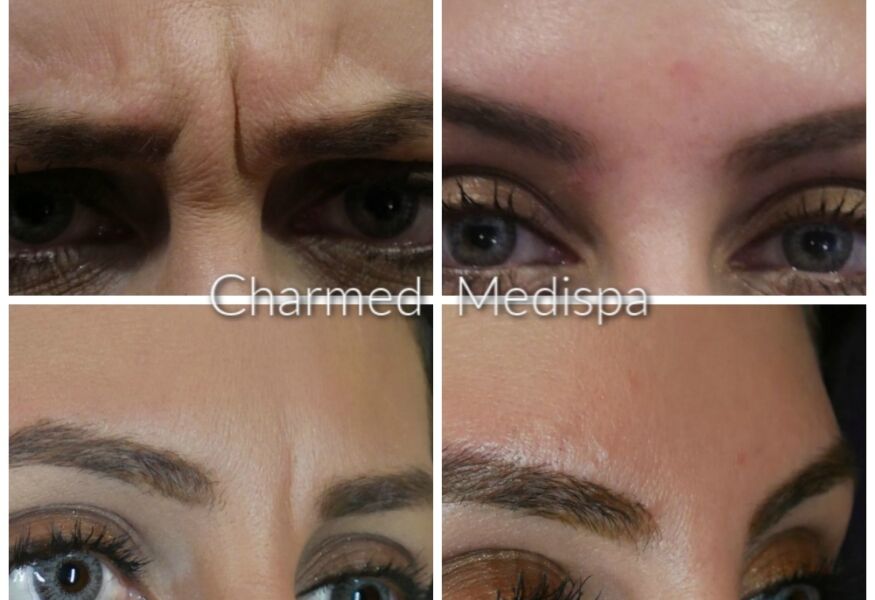 Results of relaxing muscles between the brows.