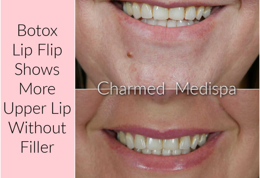 Botox lip flip to see more upper lip when you smile.