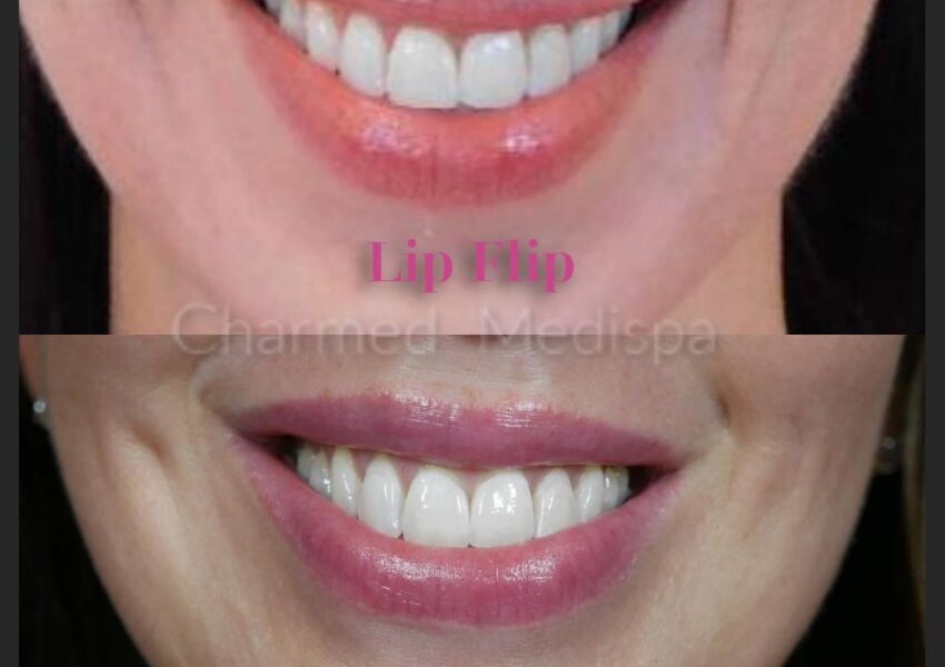 Botox lip flip to see more upper lip when you smile.
