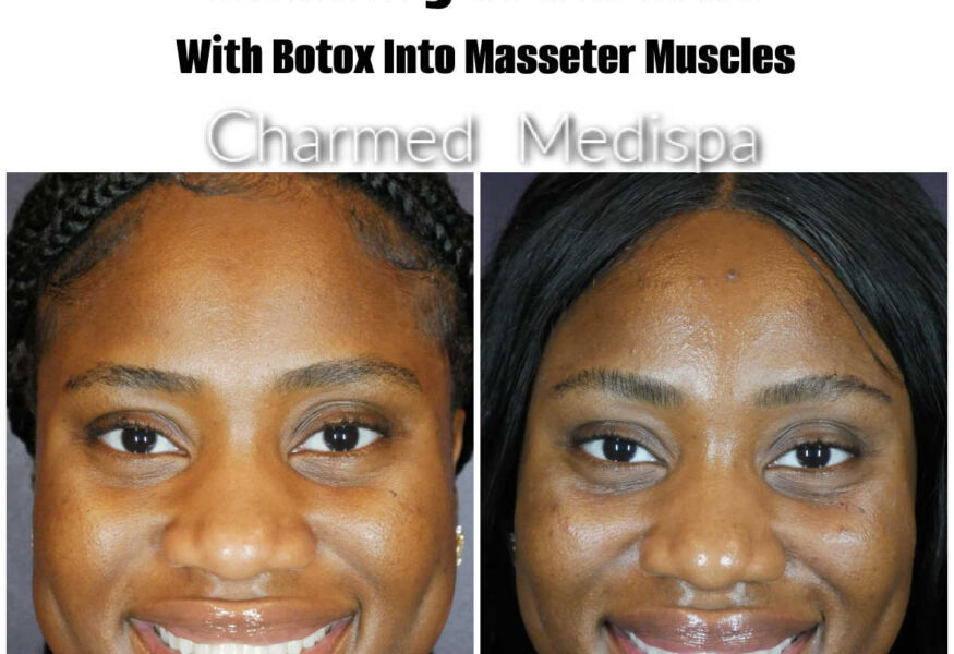 Using Botox injection into the massters muscles the face was slimmed and tension was decreased.