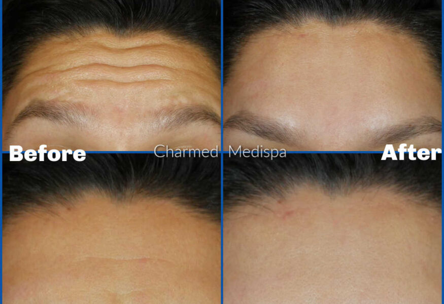 Botox results between brows and forehead to smooth lines and folds. Charmed Medispa provides advanced techniques in Botox.