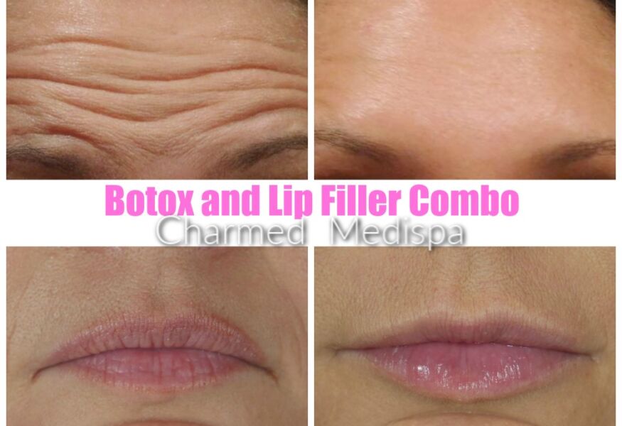 Botox and Filler. Botox to forehead lines and filler to lips. Our Delaware Med Spa has advanced techniques and Delaware's most experienced provider.