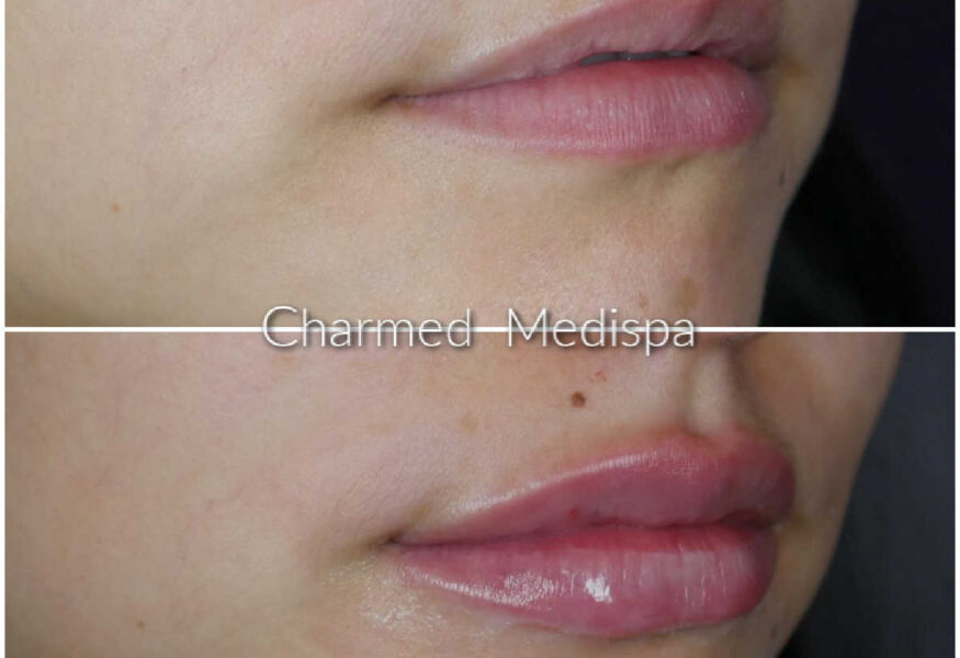 Lip filler with one syringe. Beautiful results at our Delaware med spa with our advanced provider.