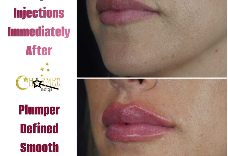 Before and after lip injections with dermal filler at our Newark Delaware med spa.