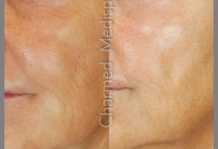 Microneedling of the face to smooth wrinkles, fine lines and create collagen stimulation.