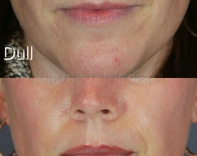 Transformation of the skin with ZO Skin Health system to maximize cellular skin health.