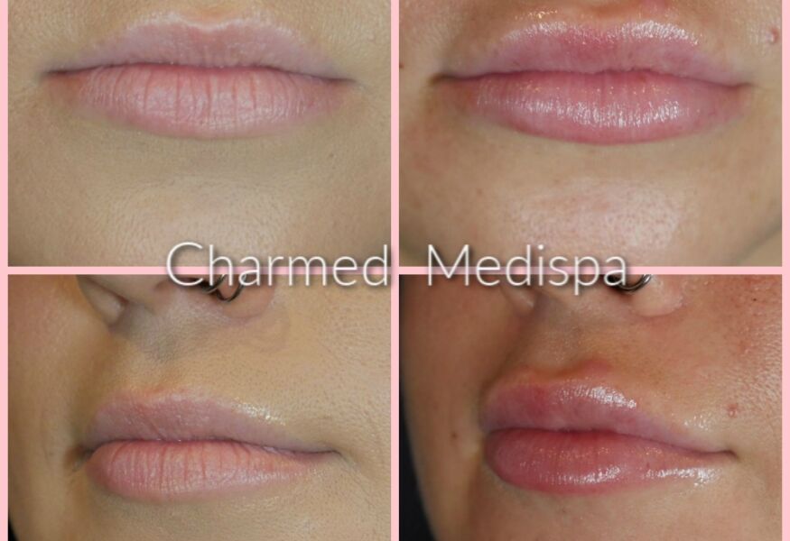 Lip filler results Charmed Medispa Delaware