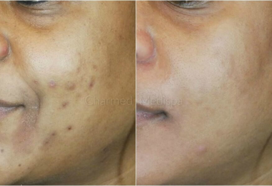 Results of ZO Skin Health at our Delaware Med Spa. Charmed Medispa specializes in complex skin issues like acne, rosecea and enlarged pores.