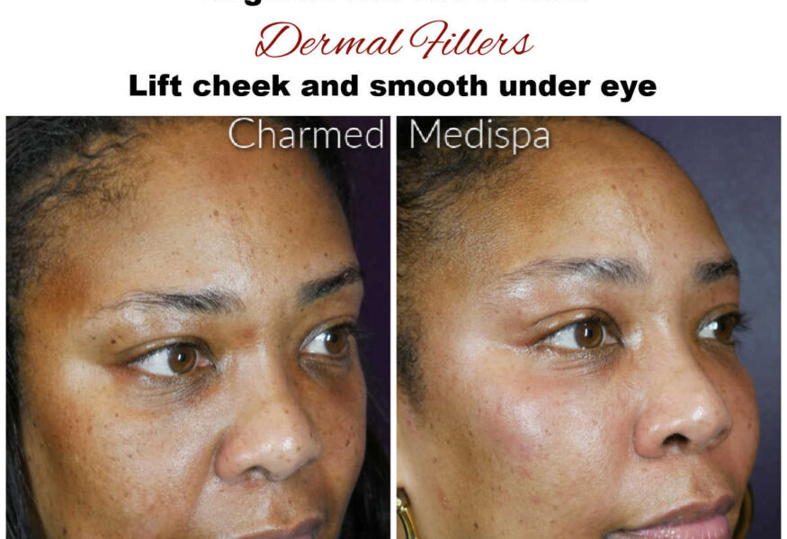 ZO Skin Health was used to improve melasma, deep excess pigmentation and to revive her skin on a cellular level. Dermal fillers were placed in the cheeks to improve contour, under eye rejuvenation and to balance her facial structures.