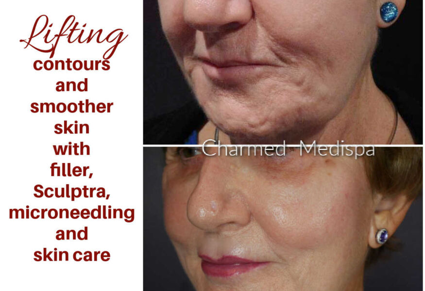 Facial contours were improved with the precise placement of dermal fillers around the mouth and cheeks. Sculptra Aesthetic was used to stimulate collagen and improve her skin laxity. ZO Skin Health and microneedling were used to improve the tone, texture and health of her skin.