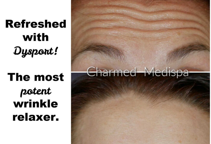 Treatment of forehead and between brows with Dysport - the Botox alternative. Dysport is more potent than other treatment options and can last longer.