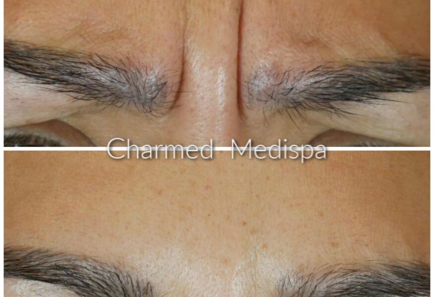 Botox results between the brows Delaware med spa