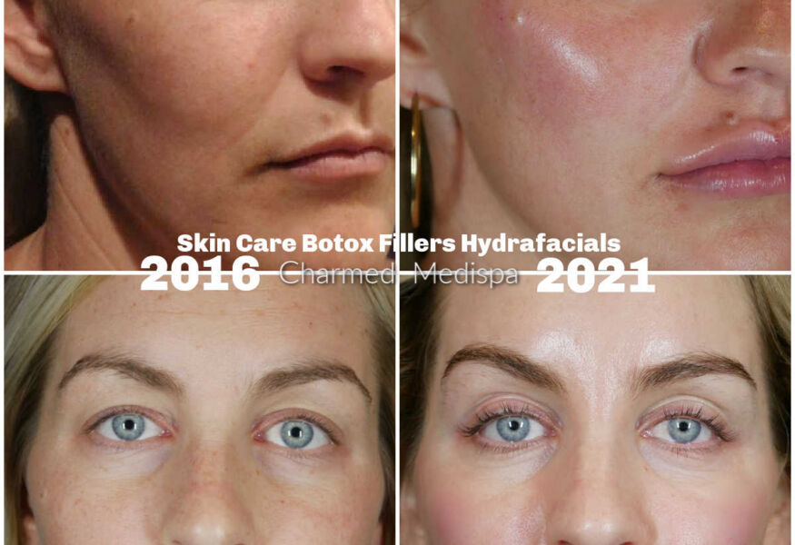 Botox fillers skin care and hydrafacials for rejuvenation and anti-aging at Charmed Medispa in Newark, Delaware.