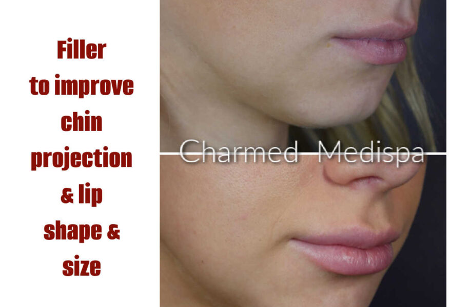 Dermal filler was used to enhance chin projection and smooth and plump the lips.