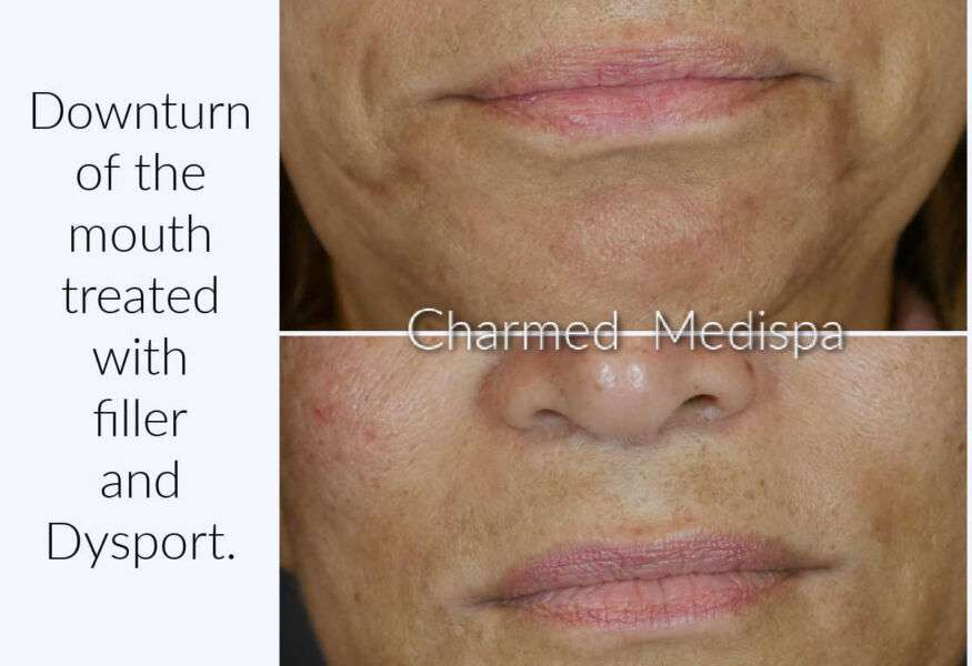 Dermal filler was used with Dysport to lift the downturn of the mouth.