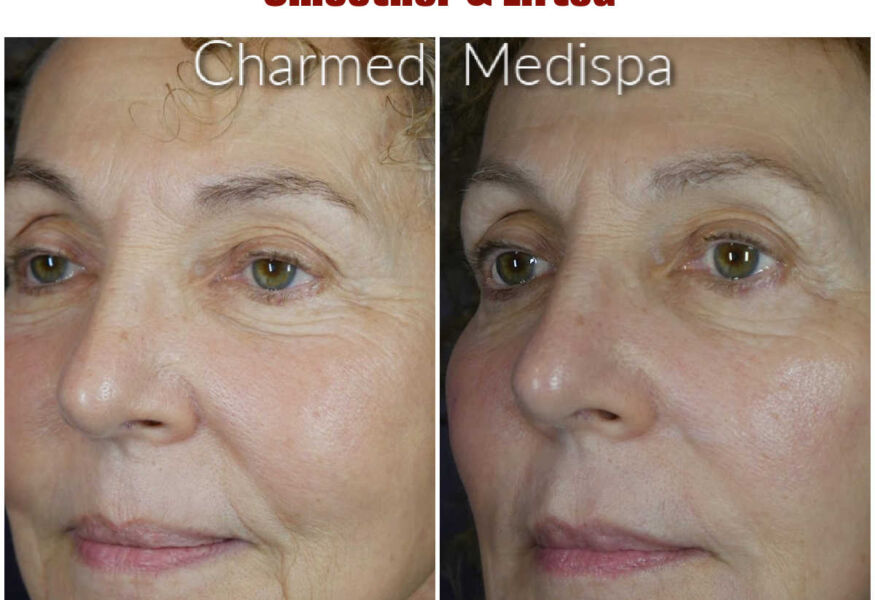 Using dermal filler to lift and contour the face for a more youthful appearance, less jowls and sagging.