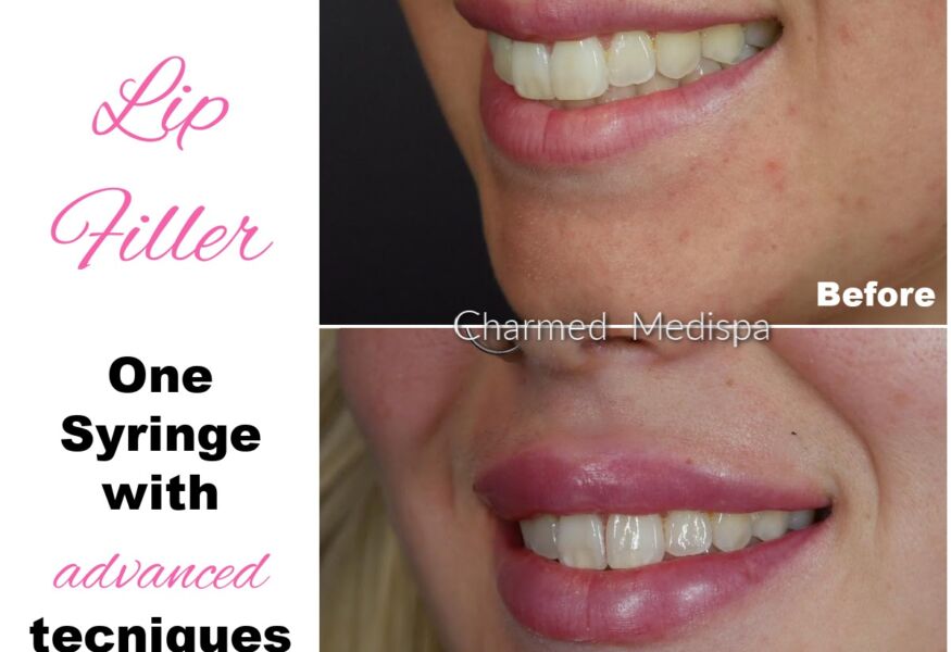 Lip filler treatment with advanced techniques at Charmed Medispa Newark, Delaware