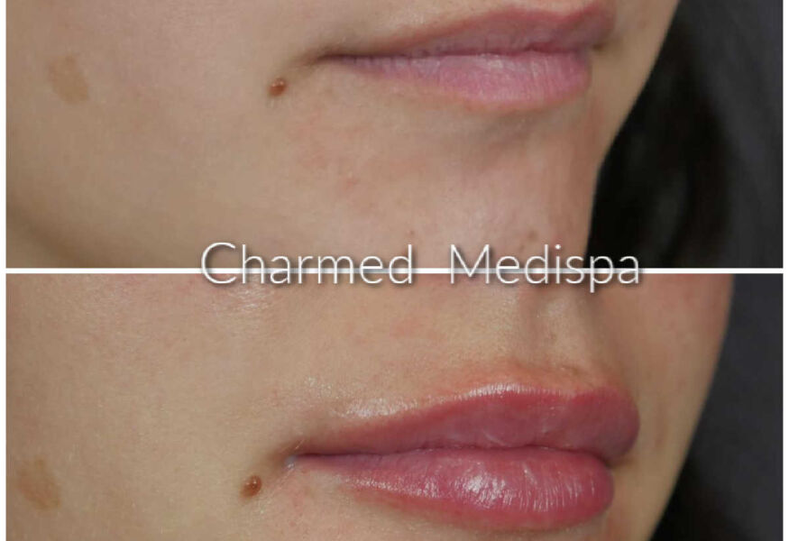 Plumper, smoother lips with dermal filler at Charmed Medispa in Newark Delaware
