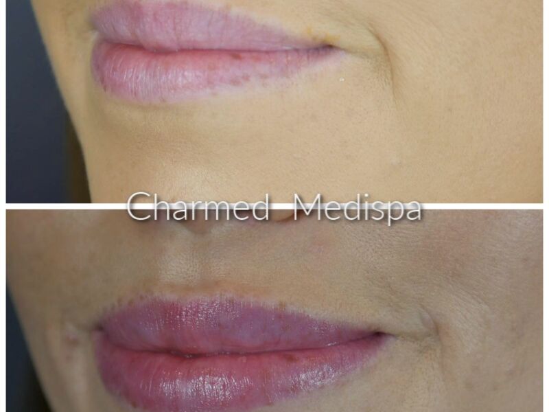 Lip enhancement with lip filler upper and lower lips