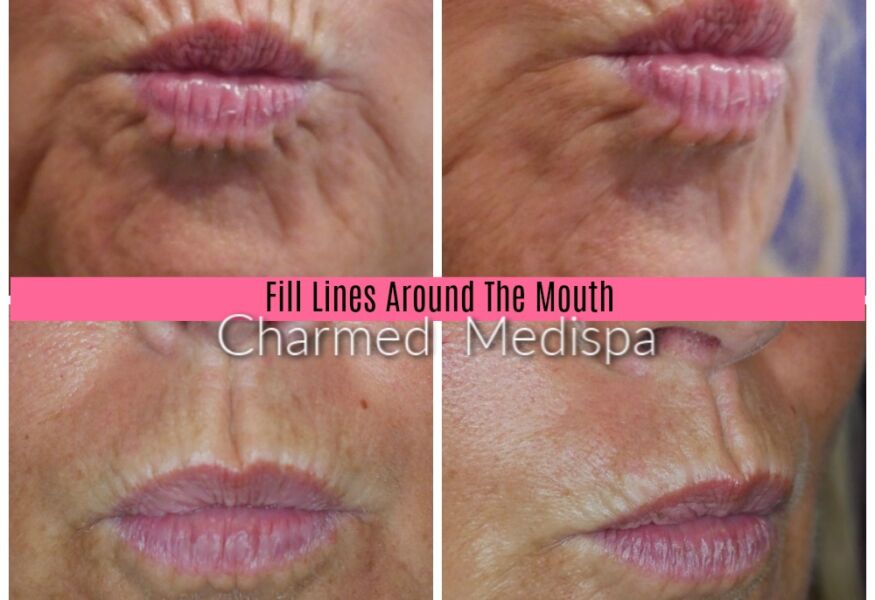 Lip line filler results Delaware med spa
