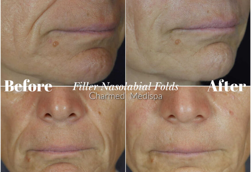 Delaware med spa fillers