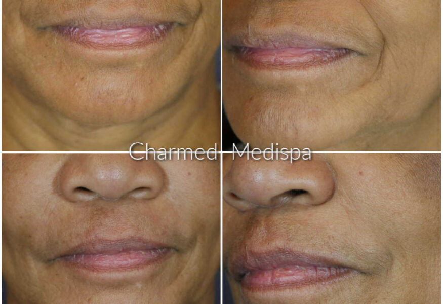 Nasolabial fold filler results using two syringes of HA filler at Charmed Medispa in Delaware