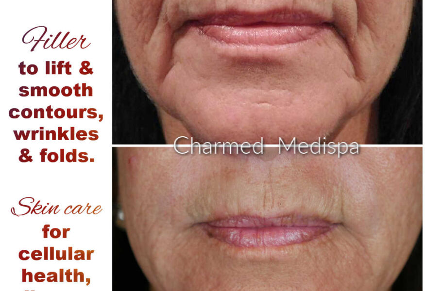 Filler injections around the mouth to smooth and lift the skin and contours. ZO Skin Health products to restore cellular health and vitality.