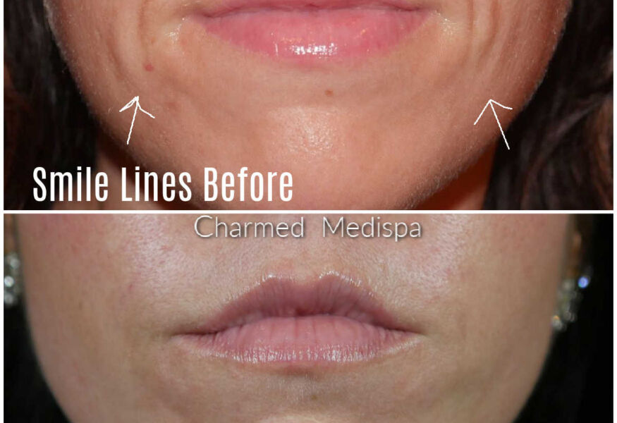 Delaware med spa performing dermal fillers to soften and smooth smile lines.