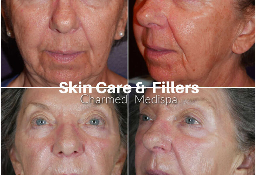 ZO Skin Health improved her redness and uneven skin tones as well as sun spots. Fillers were used to lift and contour the face improving the cheeks and around the mouth.