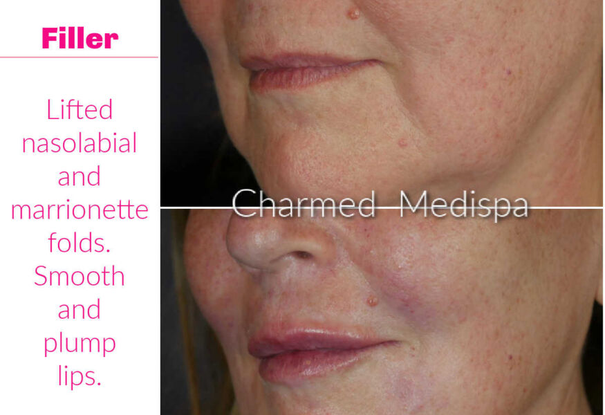 Filler used to soften the folds around the mouth and to smooth and plump the lips.