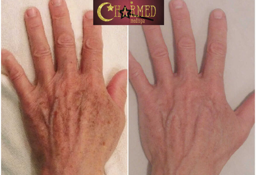 Improvement of sun damage and uneven skin tones with IPL, also known as Intense Pulsed Light, at Charmed Medispa.