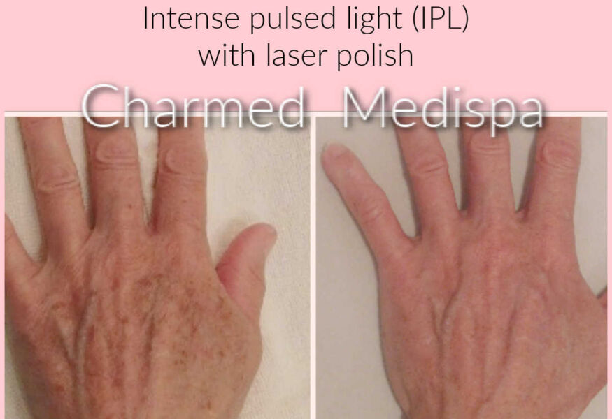 Laser resurfacing with IPL of the hands to remove wrinkles and sun damage at Charmed Medispa.