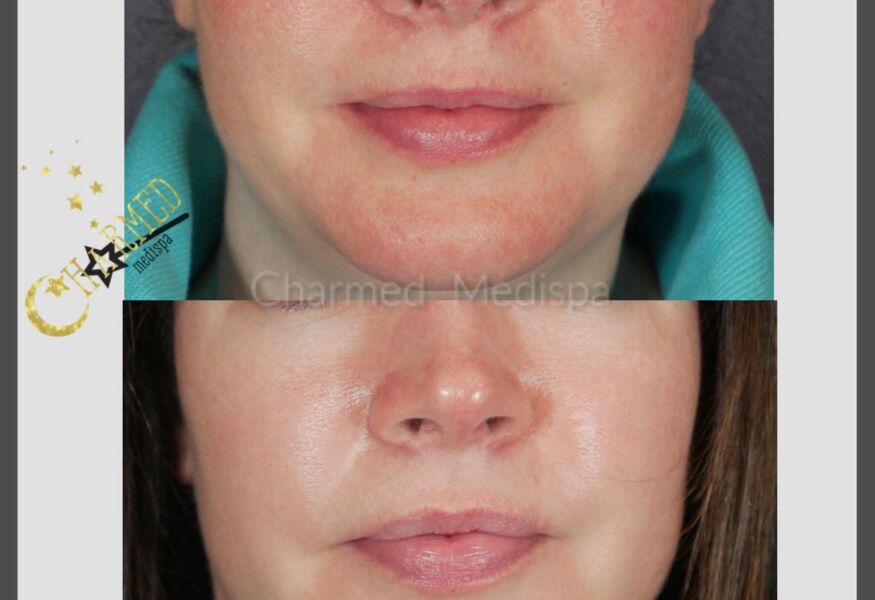 Intense Pulsed Light Treatment Full Face Results Charmed Medispa