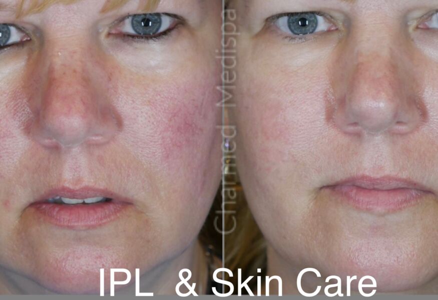 Intense Pulsed Light Treatment of the face. Beautiful results with one IPL.