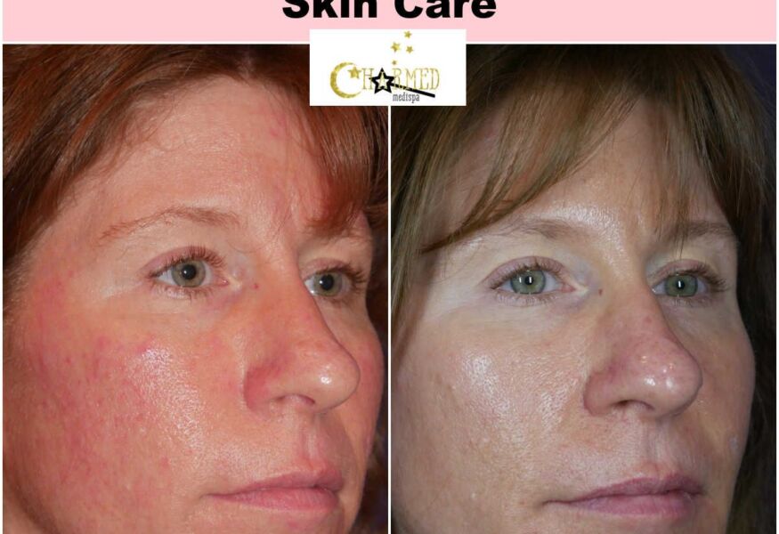 Look at the incredible results of combination therapy with IPL and microneedling with exosomes. There is significant decrease in redness and her skin is remarkably improved.