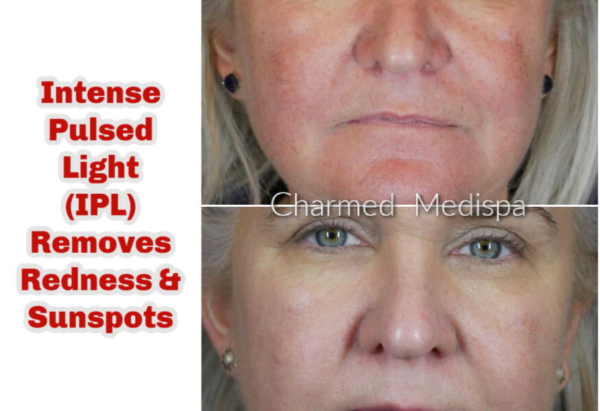 IPL results on the face to improve redness and sun spots.