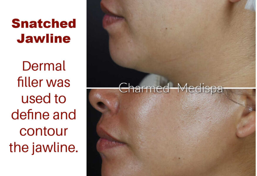 Dermal fillers were used to lift and contour the jawline creating balance and definition.