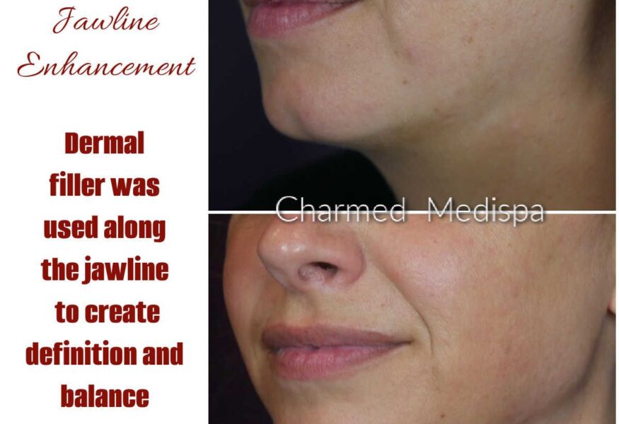Dermal fillers were used to contour and enhance the jawline.