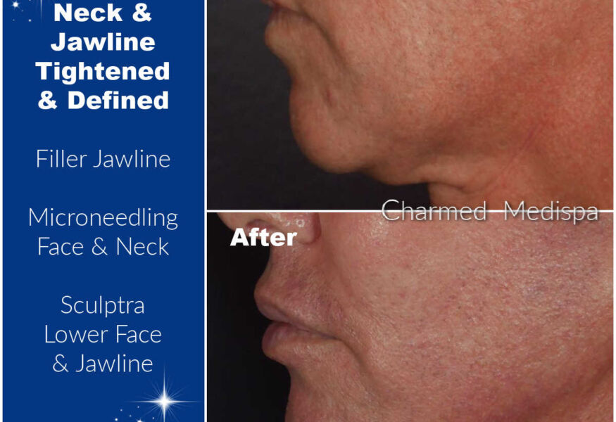 Jawline, chin and jowl filler. Microneedling face and neck. Sculptra to lower face and jawline