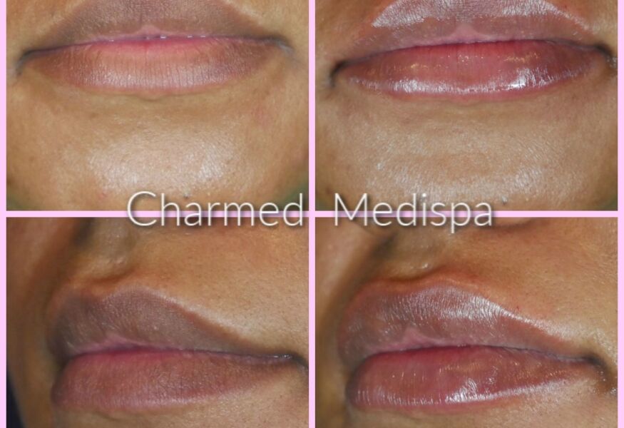 Lip filler to smooth and plumb the upper and lower lip