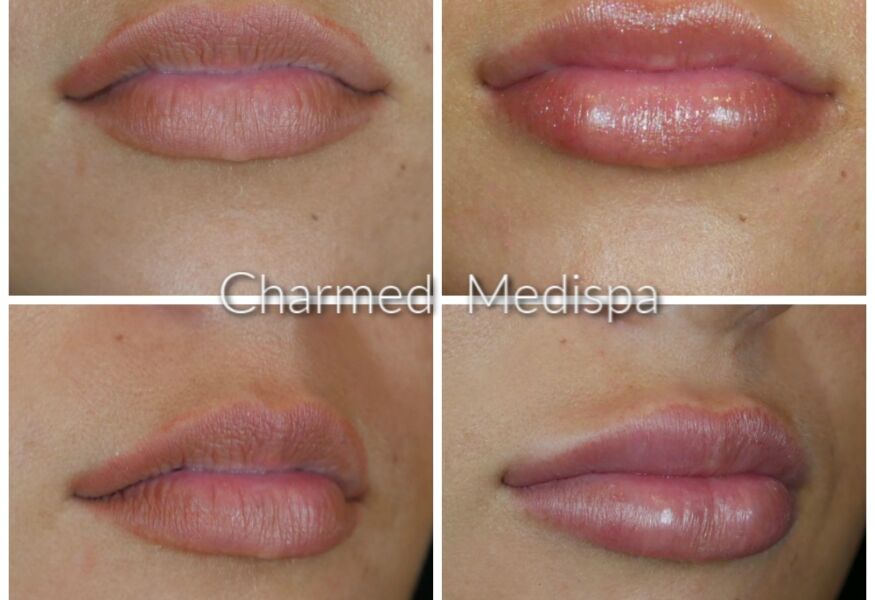 Lip Filler Newark Delaware