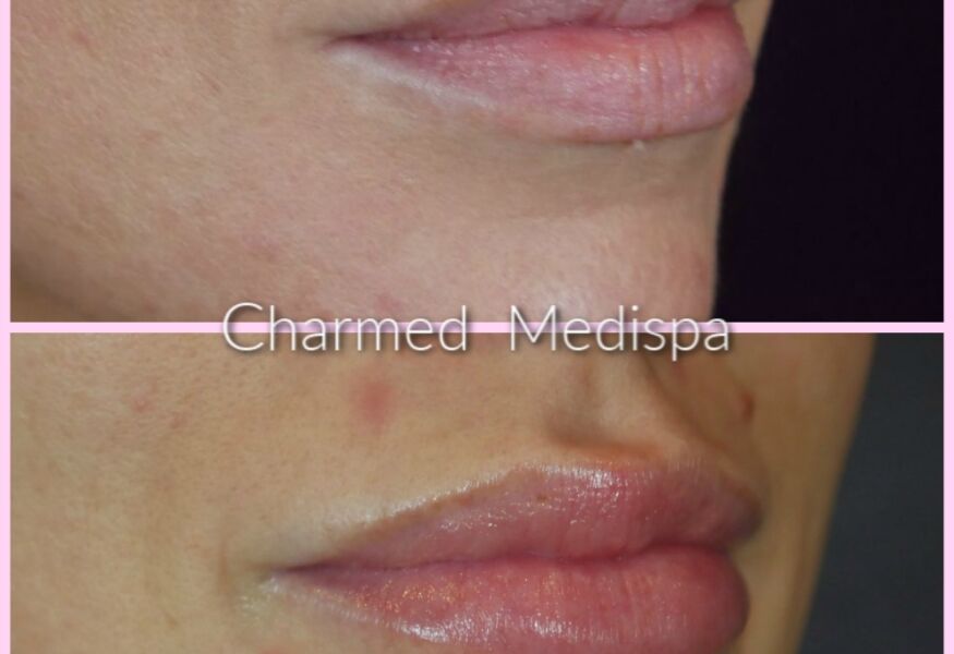 Lip filler enhancement to shape and contour the lips. Natural looking results at our Delaware med spa.