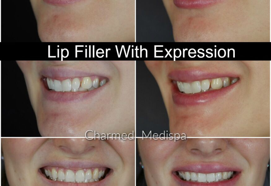 Delaware med spa lip filler