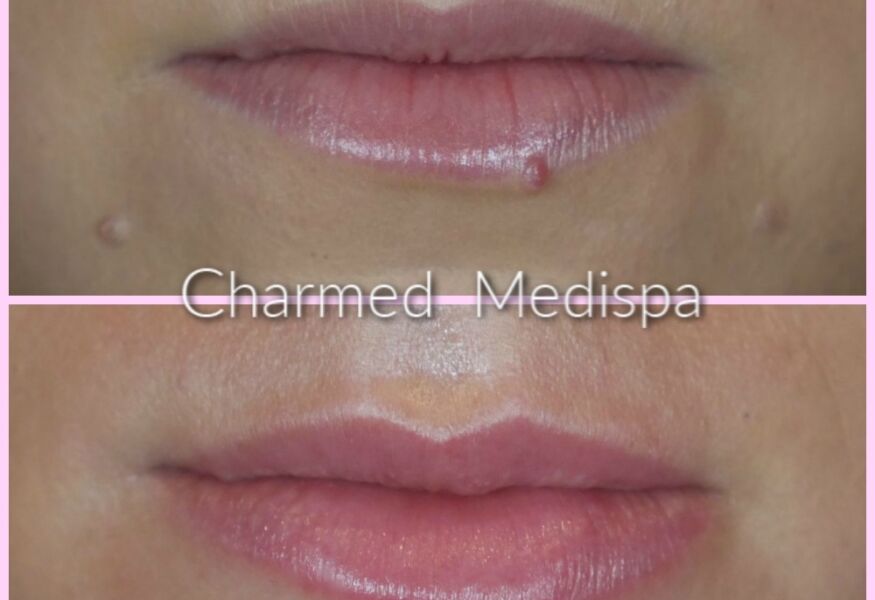 Lip Filler results with one syringe of filler.