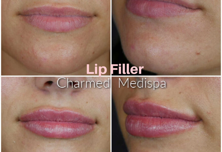 Expert nurse injector at Charmed Medispa in Newark, Delaware, used one syringe of filler to plump and smooth the lips.