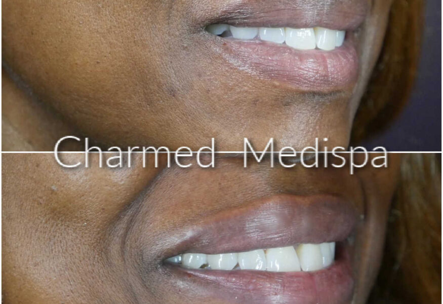 Smoother, plumper lips with one syringe of filler at Charmed Medispa